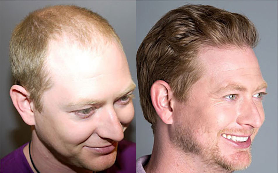 Hair Transplant Beforeafter Results For Men Bosley Hair Transplant 