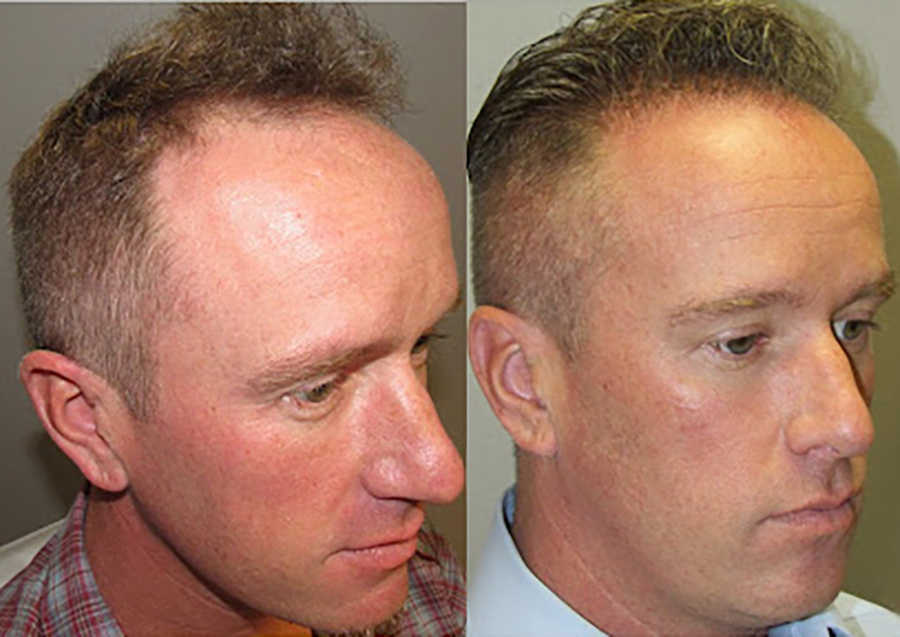 Hair Transplant Beforeafter Results For Men Bosley Hair Transplant