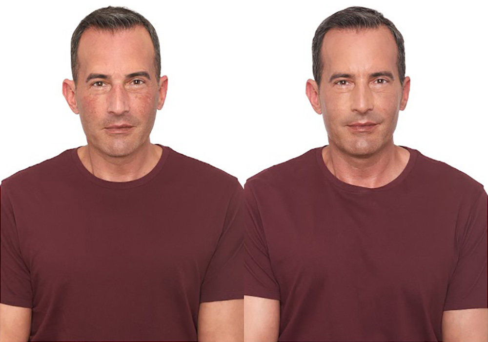 Bosley patient Jeff P before and after