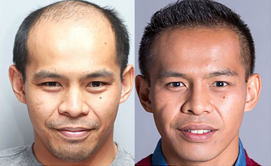 Hair Transplant Before/After Results for Men Bosley Hair Transplant